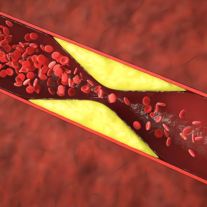 3 Coronary artery disease